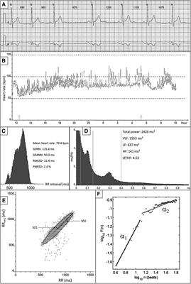 The autonomic nervous system in atrial fibrillation—pathophysiology and non-invasive assessment